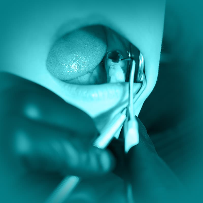 Curso: Imersão em Endodontia em Dentes Decíduos — Imersão