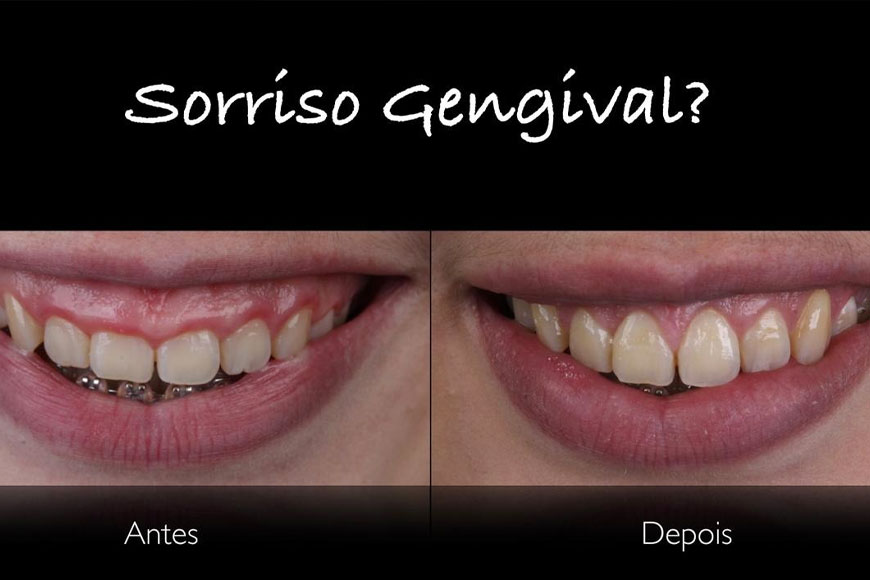 Gengivoplastia - O que é? Compare o antes e depois - CEEPO - Centro ...